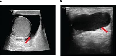 Paratesticular metastasis from colorectal adenocarcinoma presenting as hydrocele: a rare case report and literature review